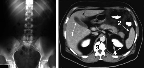 CT scan - gallbladder surrounded by liver; spleen, abdominal