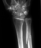 Radiograph of a broken arm.