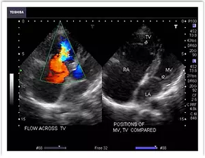 Echocardiography - Ebsteins anomaly